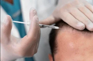 PRP Hair Restoration